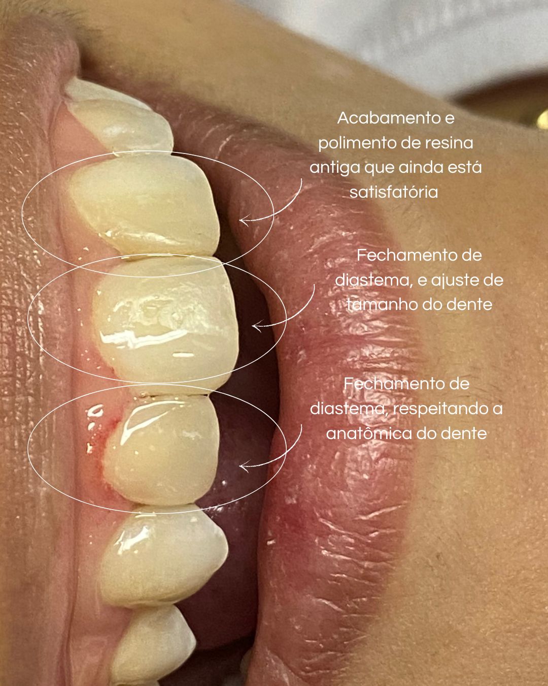 Antes e Depois Ortodontia